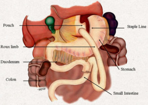 Laparoscopic-Gastric-Bypass