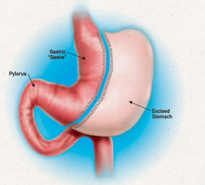 Sleeve-Gastrectomy